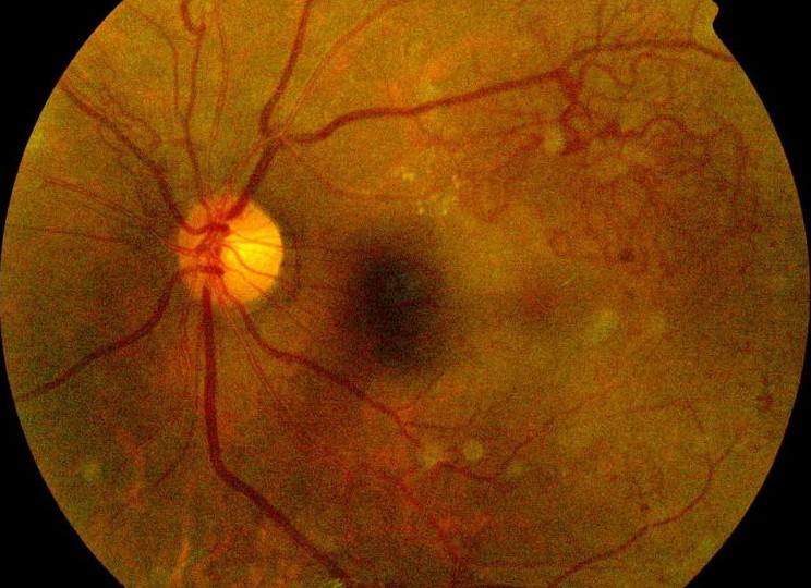 黄斑水肿医治.jpg 黄斑水肿医治.jpg