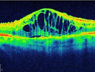 如何医治黄斑水肿.jpg 如何医治黄斑水肿.jpg