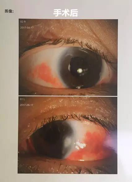 成都易游体育白内障.jpg 成都易游体育白内障.jpg