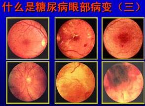 糖尿病视网膜病变医治.jpg 糖尿病视网膜病变医治.jpg