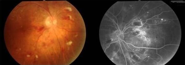 视网膜中央动脉是颈内动脉的分支，它和供应脑部的动脉一样，彼此之间无吻合支，属于终末动脉，一旦发生阻塞，血流中断即成为视网膜中央动脉阻塞，被供应区的视网膜立即缺氧、变性。两小时以后，即使 了血供，视力遭受严重破坏，很难 。因此，视网膜中央动脉阻塞是眼科的一种危重急症，必须予以紧急诊治。.jpg