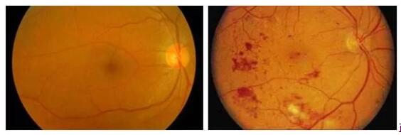 70%的糖尿病患者会出现全身小血管和微血管病变，影响全身组织的供养，进而导致一系列严重的并发症。糖尿病也可以引起一系列眼部疾病，包括白内障、青光眼、眼球运动障碍等，其中较为严重的就是糖尿病视网膜病变，它可以严重影响视力的一种疾病，已经成为四大主要致盲疾病之一。糖尿病引起的失明者比一般人高10到25倍。据有关资料统计，糖尿病患病时间越长，患者出现视网膜病变的比率越大。.jpg