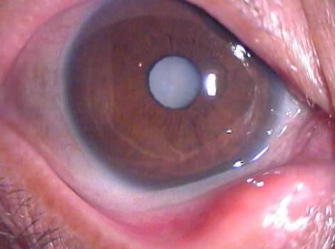 　　白内障是指眼睛的晶状体由透明变成不透明，阻碍光线进入眼内，从而影响了视力。初期混浊对视力影响不大，而后逐渐加重，直至明显影响视力甚至失明。我国目前约有500 人患有白内障，每年新增40 人，80岁以上老年人的白内障发病率近99%，随着我国老龄化进程的加剧，白内障在我国的发病人数仍有升高趋势。.jpg