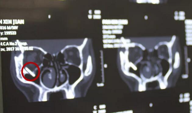 当地的医生跟我说，如果做手术他们只有50%的把握能把我爸眼睛里的东西取出来，而且还不知道会不会伤到眼睛其他部位，我实在是不放心。”刘先生的儿子回忆道。孝顺的儿子不想让爸爸的眼睛承受“50%失败的可能性”，在经过多方打听后，知道福州眼科医院副院长、眼眶病科李谦益主任是这方面的“好手”,他决定带着爸爸到福州寻找 .jpg