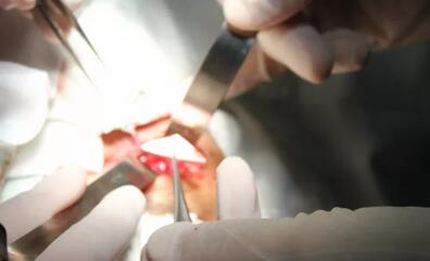 当地的医生跟我说，如果做手术他们只有50%的把握能把我爸眼睛里的东西取出来，而且还不知道会不会伤到眼睛其他部位，我实在是不放心。”刘先生的儿子回忆道。孝顺的儿子不想让爸爸的眼睛承受“50%失败的可能性”，在经过多方打听后，知道福州眼科医院副院长、眼眶病科李谦益主任是这方面的“好手”,他决定带着爸爸到福州寻找 3.jpg