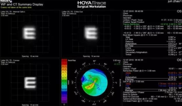 白内障手术已发展至屈光手术时代(一*次白内障屈光手术可解决白内障、老花眼、近视眼、远视眼、散光等多种眼病)，手术 对于眼科医生来说变得更加容易，而术前准确的诊断、评估、测量和计算，为患者设计个性化的手术方案，成为白内障医生面对的难题。2.jpg