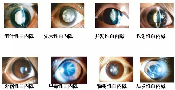 长时间在白色光亮污染环境下工作和生活的人，尤其是长时间接触过强的光线，视网膜和虹膜都会受到程度不同的损害，较终也会伤害晶状体，时间一长，就会使视力下降，使晶状体蛋白发生变性，形成混浊，发展成为白内障1.jpg