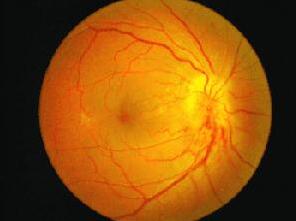 糖尿病除了引起心、脑、肾等全身多脏器损害，也引起多种眼病， 如：糖尿病性视网膜病变、白内障、新生血管性青光眼、视神经病变、葡萄膜炎、眼肌麻痹复视等。所以医生建议糖尿病患者要检查眼底。糖尿病患者应该定期去眼科检查.jpg