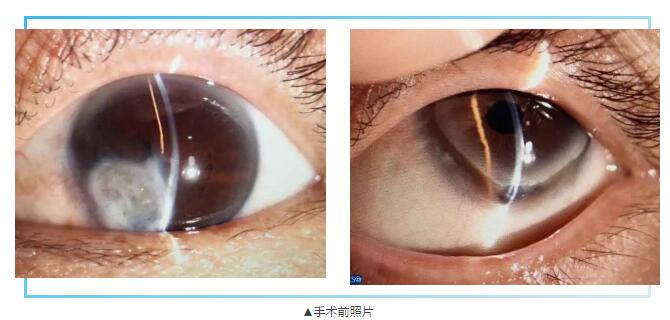 即便天气如此恶劣，合肥名人眼科医院的所有医护人员依然兢兢业业的守护在自己的岗位上。其中有两位患者分别来自安徽的蒙城和涡阳，一 角膜愈着性白斑，致虹膜前后黏连，视力仅有手动。另一 角膜严重边缘变性致穿孔，急需通过角膜移植手术保住眼球。2.jpg