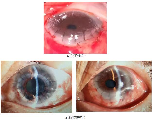 即便天气如此恶劣，合肥名人眼科医院的所有医护人员依然兢兢业业的守护在自己的岗位上。其中有两位患者分别来自安徽的蒙城和涡阳，一 角膜愈着性白斑，致虹膜前后黏连，视力仅有手动。另一 角膜严重边缘变性致穿孔，急需通过角膜移植手术保住眼球。.jpg