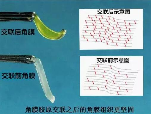 角膜胶原交联(Corneal Cross Linking，CCL)医治：使用370纳米波长的紫外线，激活核黄素(一种光敏感剂)，使其转化成活性氧族，活性氧族再诱导角膜胶原纤维的氨基之间发生化学交联反应，使角膜胶原纤维直径增粗、提*角膜基质对多种降解酶作用的抵抗力等多重生物学效应，从而使角膜基质的机械强度增加2.jpg