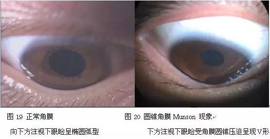 每年寒假期间，厦门眼科中心都会接诊不少学生圆锥角膜患者。大部分学生都是出现了近视、散光,戴眼镜  不佳的情况下来就诊的。厦门眼科中心眼表及角膜病专科吴护平主任提醒：青少年视力下降明显要警惕圆锥角膜1.jpg