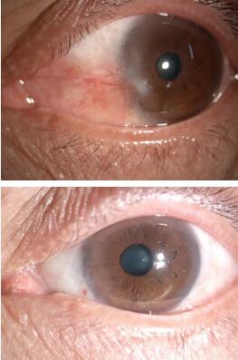 姚颖医生为文先生做了详细检查后，制定了左眼的翼状胬肉切除术、联合自体干细胞移植术、联合羊膜覆盖术的手术方案，这才为他解决了胬肉的麻烦与痛苦。手术一个月后，朋友见了文先生都说他的眼睛  了正常，看不出一点手术过的痕迹1.jpg