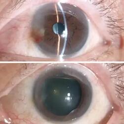 姚颖医生为文先生做了详细检查后，制定了左眼的翼状胬肉切除术、联合自体干细胞移植术、联合羊膜覆盖术的手术方案，这才为他解决了胬肉的麻烦与痛苦。手术一个月后，朋友见了文先生都说他的眼睛  了正常，看不出一点手术过的痕迹2.jpg