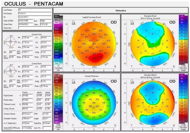 圆锥角膜是一种角膜扩张性疾病，患病后角膜中央或偏中央区域会发生局部变薄向外扩张，导致散光，并随着病情进展逐渐出现视力下降、 不良、视物扭曲变形、虹视等，极大影响生活，严重者可致盲。.jpg