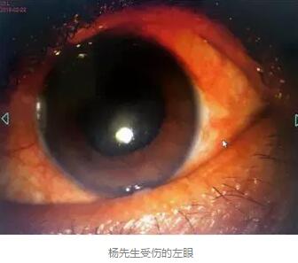 白内障和青光眼都是致盲性眼病，其中青光眼的病程不逆转。杨先生拖延伤情导致同时并发白内障、青光眼的情况，十分令人惋惜。”出名眼科专家、成都易游体育陈晓明教授表示2.jpg