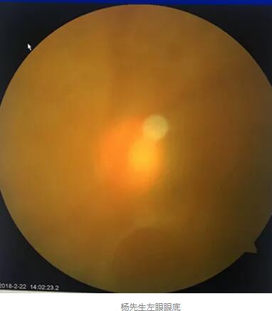 白内障和青光眼都是致盲性眼病，其中青光眼的病程不逆转。杨先生拖延伤情导致同时并发白内障、青光眼的情况，十分令人惋惜。”出名眼科专家、成都易游体育陈晓明教授表示3.jpg
