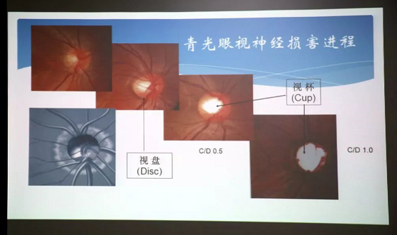 3月10日上午，深圳易游体育“早查监控，守护光明”大型青光眼公益科普讲座在六楼 举行，本次活动旨在让更多人了解青光眼的潜在危害、重视眼检查， 预防青光眼。由深圳易游体育青光眼病科 席专家成洪波博士、傅培副院长现场面对面解答疑问，与参会者的互动交流，让更多深圳市民提*对青光眼的认识与防治知识3.png