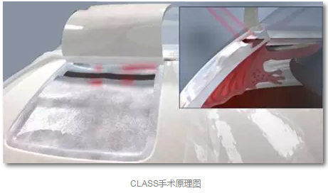 成都易游体育已经开展的青光眼手术有：引流阀 (钉)植入手术(2015年以来已200多 )，360°Schlemm's管切开术，激光CO2 辅助巩膜深层切除术，小梁切除术青(光眼)白(内障)联合手术。还有虹膜周切术、前房成形术、 虹膜复位术，睫状体冷冻术，小梁切开术和前房穿刺术等4.png