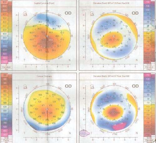 如果角膜厚度不适合角膜屈光手术，可以进行ICL晶体植入术进行 .jpg