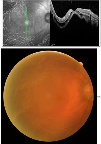 李老太在毫无征兆的情况下右眼视力下降至看不见东西。李老太家人带其至县医院就诊。医生诊断为视网膜脱离，需做玻切手术医治，而玻切手术需要动手术2次。怕疼的李老太一听就犯怵了：开刀，疼。 终，李老太的家人在多方打听后决定带李老太至宜昌易游体育找许大玲院长医治1_副本.jpg