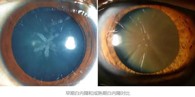 白内障超声乳化术是如今新式微创白内障手术，它创伤小、愈合快，术后 二天 正常生活。老年人能不能承受得住白内障手术呢2.jpg