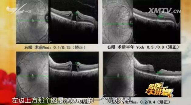黄斑裂孔是一种常见的黄斑病，是黄斑部视网膜内界膜至感光细胞层发生的组织缺损所引起的。黄斑区位于眼睛视网膜中央，它是视力 敏感区，负责视觉和色觉的视锥细胞就分布于该区域，因此 累及黄斑部的病变都会引起中心视力的明显下降、视物色暗、变形等3.jpg