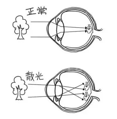近视加散光想要 ，飞秒全激光近视手术是很好的选择。 一*次近视激光手术，就可以同时 近视、合并散光。1.jpg