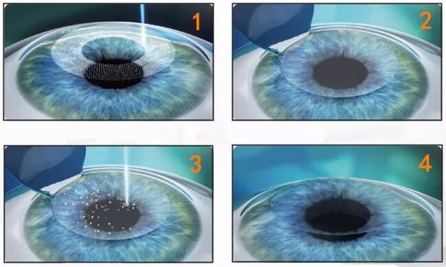 近视加散光想要 ，飞秒全激光近视手术是很好的选择。 一*次近视激光手术，就可以同时 近视、合并散光。2.jpg