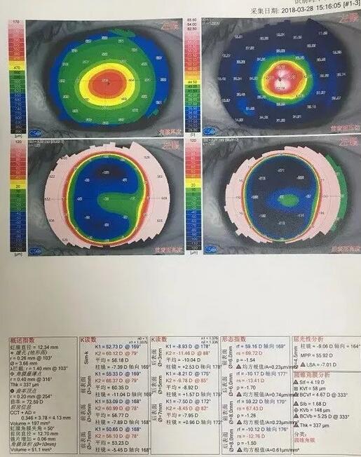 角膜移植是利用异体的正常透明角膜组织，取代浑浊病变的角膜组织，使患者复明或控制角膜病变，这在目前同种器官移植当中， 率是 高的，也是重要的复明手术之一。”在 为一位饱受圆锥角膜之苦患者 实施角膜移植之后，卢敏院长也对患者极为关心的角膜移植相关知识进行介绍。比如哪些患者适合角膜移植手术