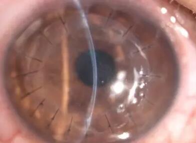 厦门眼科中心商旭敏博士介绍：角膜移植手术在所有器官移植中属于排斥反应 少的手术，随着手术器械的改进，以及手术技术的提*，目前角膜移植的 率越来越高，如排斥率较低的圆锥角膜， 率就可达到90%以上1.jpg