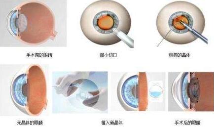 三焦点人工晶体手术原理：置换掉人眼老去的晶体，世代的晶体不仅有非常好的弹性，以往传统的白内障手术只是单纯的脱盲复明手术，更多的是解决患者 远视力。而三焦点人工晶体的问世，彻*解决了传统白内障术后仍需配镜的问题，实现了从以往‘看得见’到‘看得清、看得好’的转变.jpg