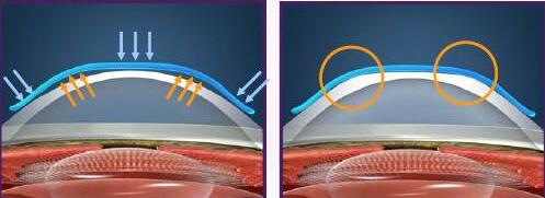 角膜塑形镜是如何 孩子近视的？.jpg