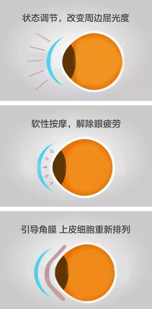 角膜塑形镜是一种硬性透气性隐形眼镜，戴在眼表可使角膜发生塑形效应，从而达到 近视度数的 。适合夜晚睡觉时配戴，白天不用戴眼镜就可以 裸眼视力，不影响学习、运动2.png