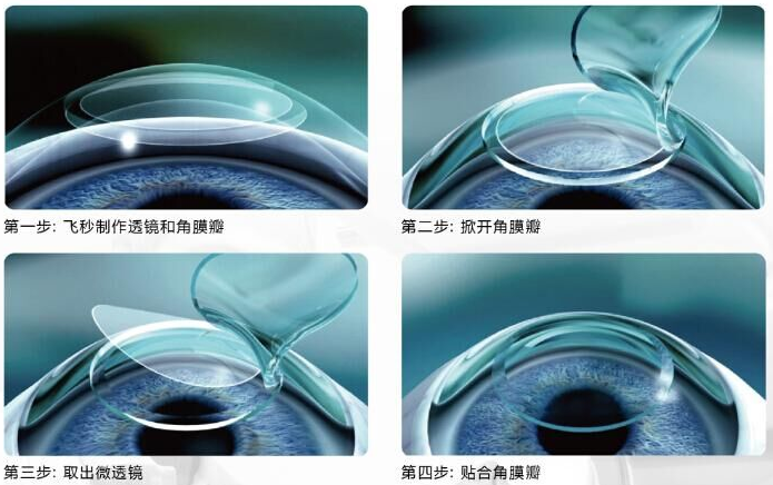 2018年征兵体检、高考体检、公务员体检，是很多近视青年 为头疼的问题，努力了多少年，职业理想近在眼前却因为视力体检不通过而破灭，是很多人都难以承受的。而摘镜手术无疑是通往理想的重要桥梁。近视摘镜手术听说过飞秒、全飞秒等近视手术.png