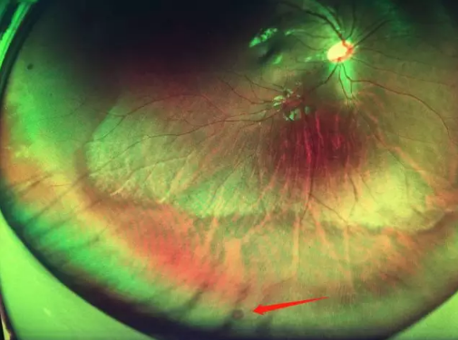 想要摘镜参军在深圳易游体育查出视网膜裂孔 细心妈妈挽救孩子视网膜1.png 想要摘镜参军在深圳易游体育查出视网膜裂孔 细心妈妈挽救孩子视网膜1.png