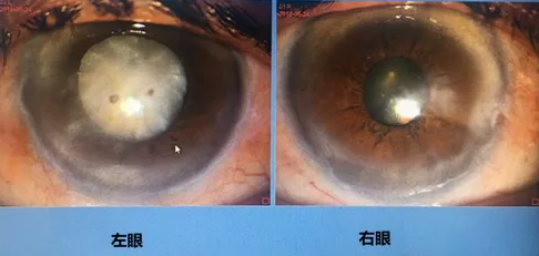 同时患 青光眼、白内障老婆婆辗转几家医院之后终于在成都易游体育顺利手术2.png