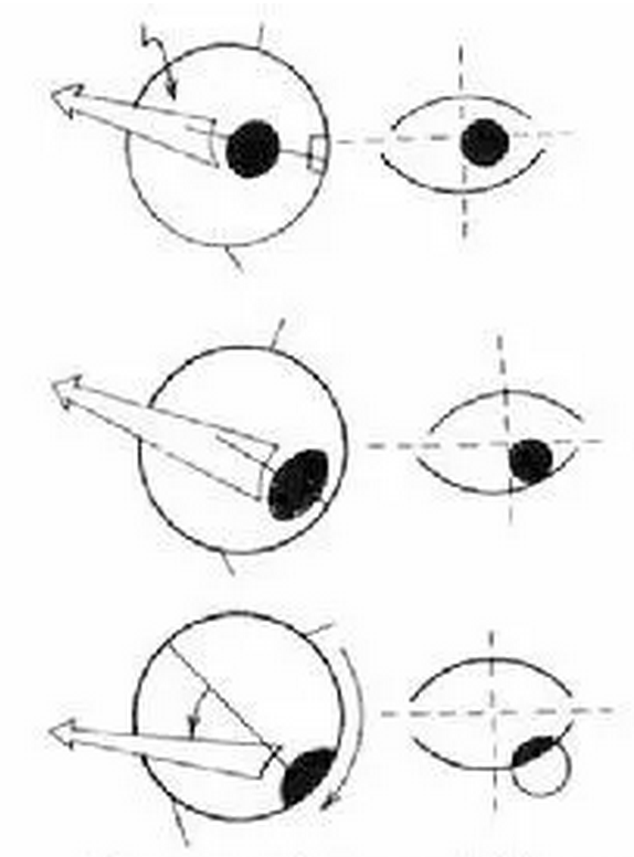 眼球后退综合症的类型与医治方式1.png