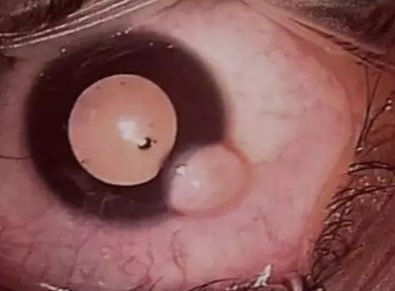 6岁小孩角膜上长瘤 在厦门眼科中心切除1.png 6岁小孩角膜上长瘤 在厦门眼科中心切除1.png