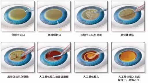 叶院长哪一种白内障手术 ，术后视觉 更好？.jpg