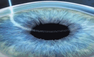 想要当兵视力不达标怎么办?易游体育有这些摘镜术式帮助你2.gif 想要当兵视力不达标怎么办?易游体育有这些摘镜术式帮助你2.gif