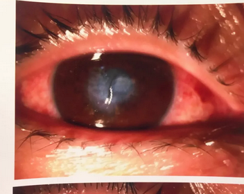 福州眼科医院出名角膜病医生姚晓明教授为一位不慎眼外伤导致角膜受损患者进行角膜移植手术1.png 福州眼科医院出名角膜病医生姚晓明教授为一位不慎眼外伤导致角膜受损患者进行角膜移植手术1.png