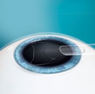 易游体育课堂ICL晶体植入术2.png 易游体育课堂ICL晶体植入术2.png