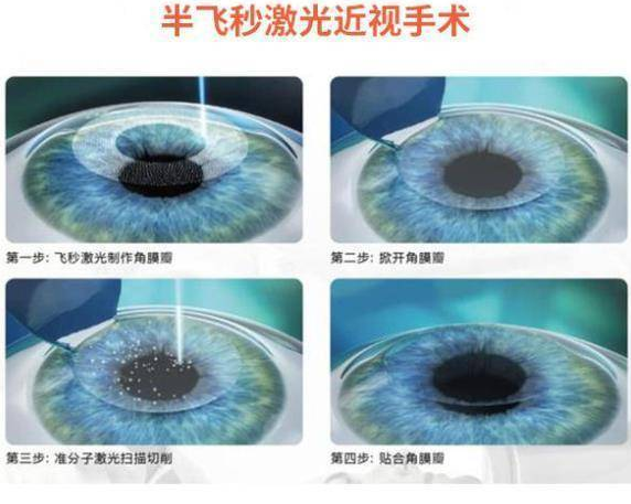 菏泽易游体育近视手术王3.png