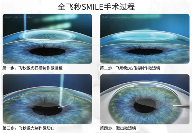 高考毕业后做近视手术，如今近视手术有了越来越高的安全性，且多样的术式可以满足不同患者的摘镜需求。1.png