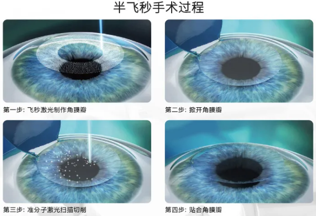 高考毕业后做近视手术，如今近视手术有了越来越高的安全性，且多样的术式可以满足不同患者的摘镜需求。3.png